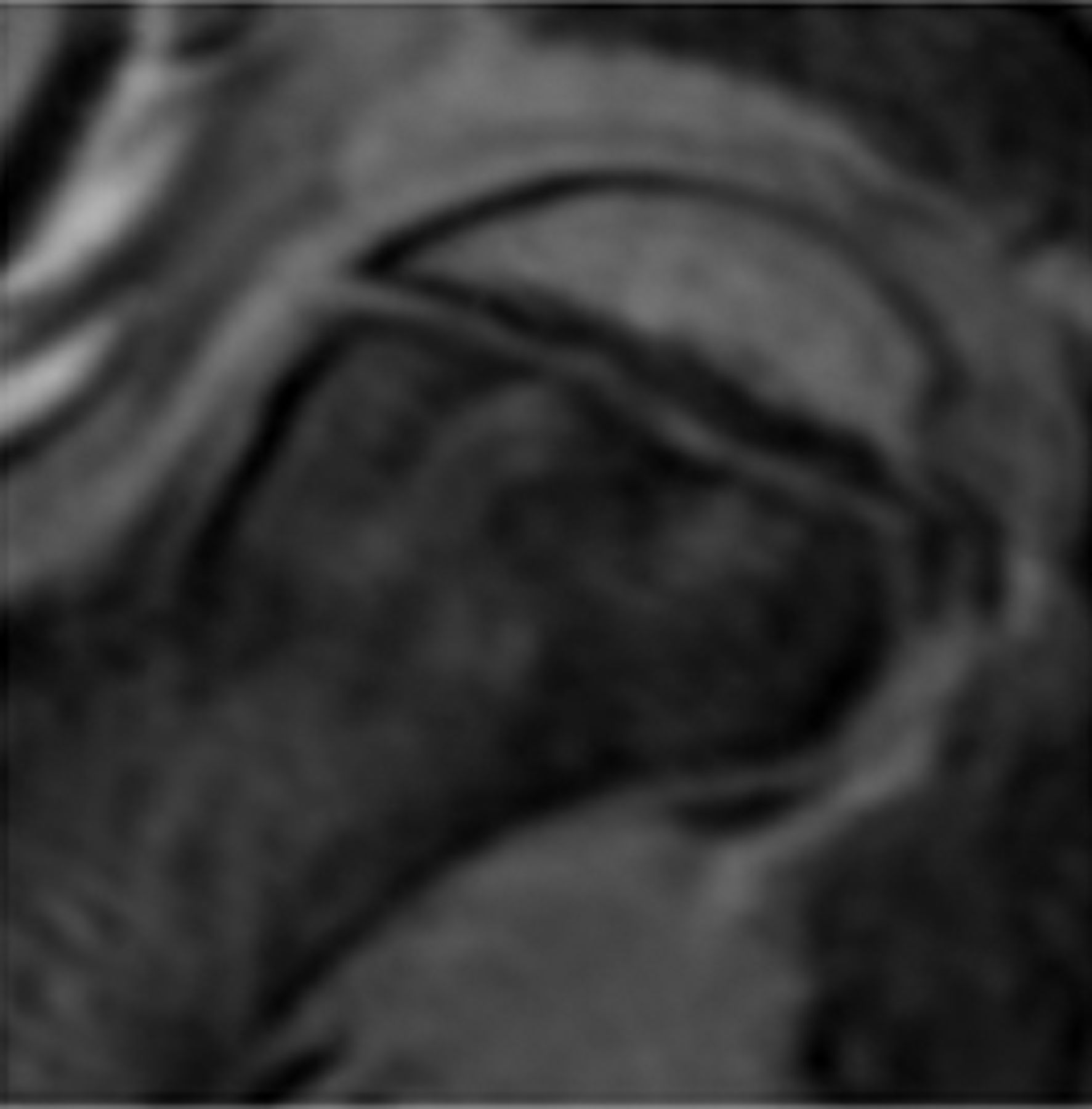 Figs. 2a - 2f 
          Representative MRI images
showing the six physeal grades in study subjects; a) grade 1, b)
grade 2, c) grade 3, d) grade 4, e) grade 5, and f) grade 6.
        