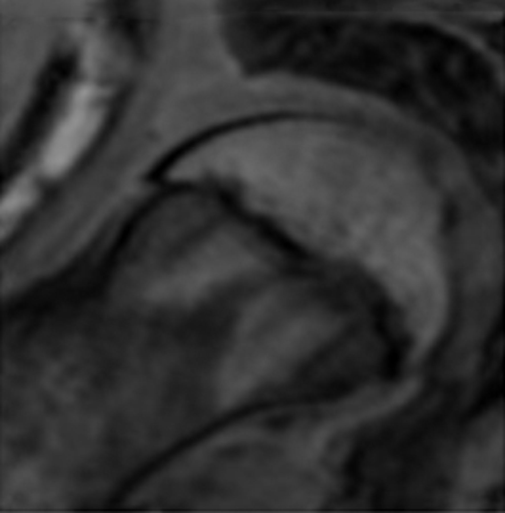 Figs. 2a - 2f 
          Representative MRI images
showing the six physeal grades in study subjects; a) grade 1, b)
grade 2, c) grade 3, d) grade 4, e) grade 5, and f) grade 6.
        