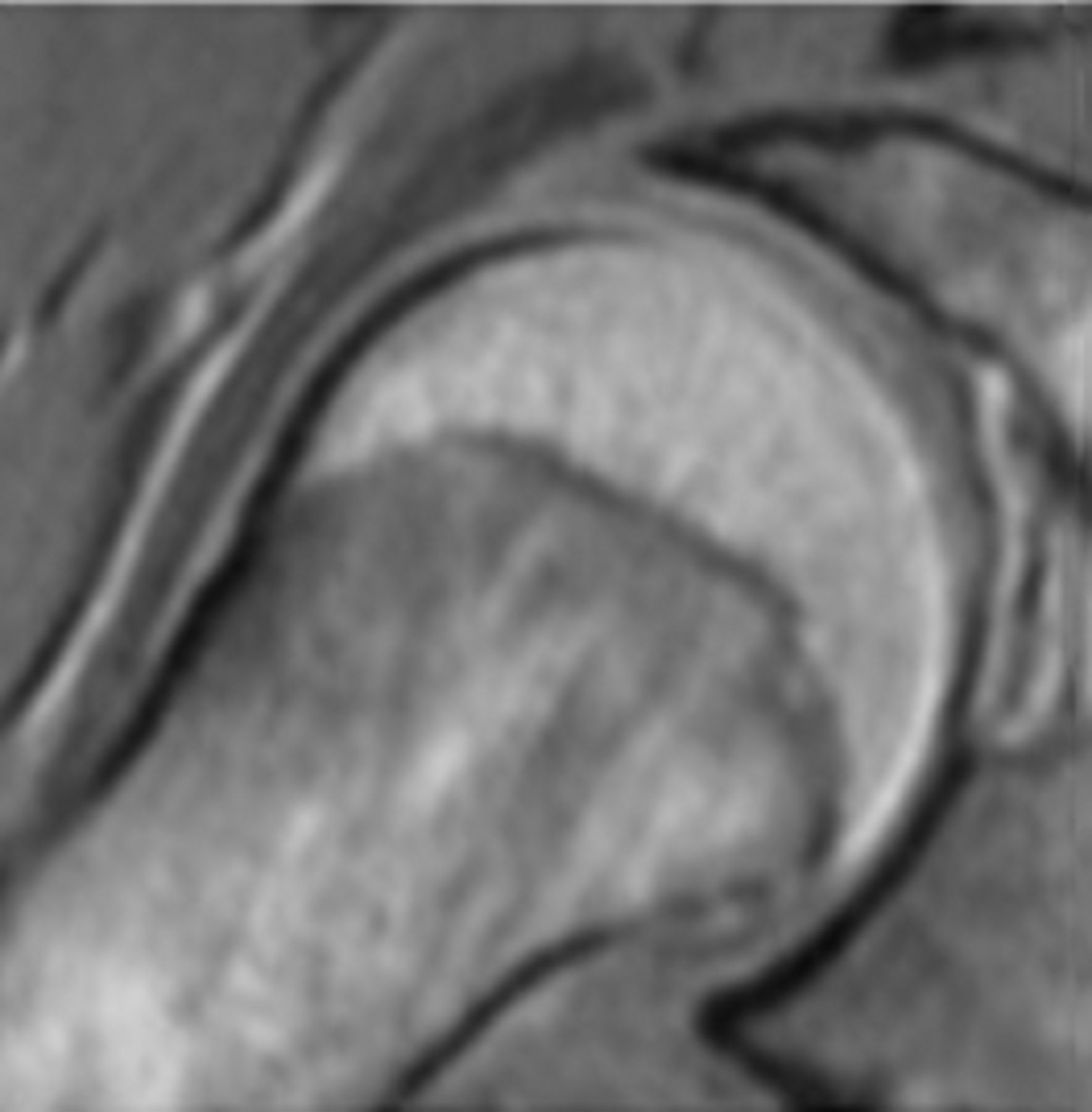 Figs. 2a - 2f 
          Representative MRI images
showing the six physeal grades in study subjects; a) grade 1, b)
grade 2, c) grade 3, d) grade 4, e) grade 5, and f) grade 6.
        