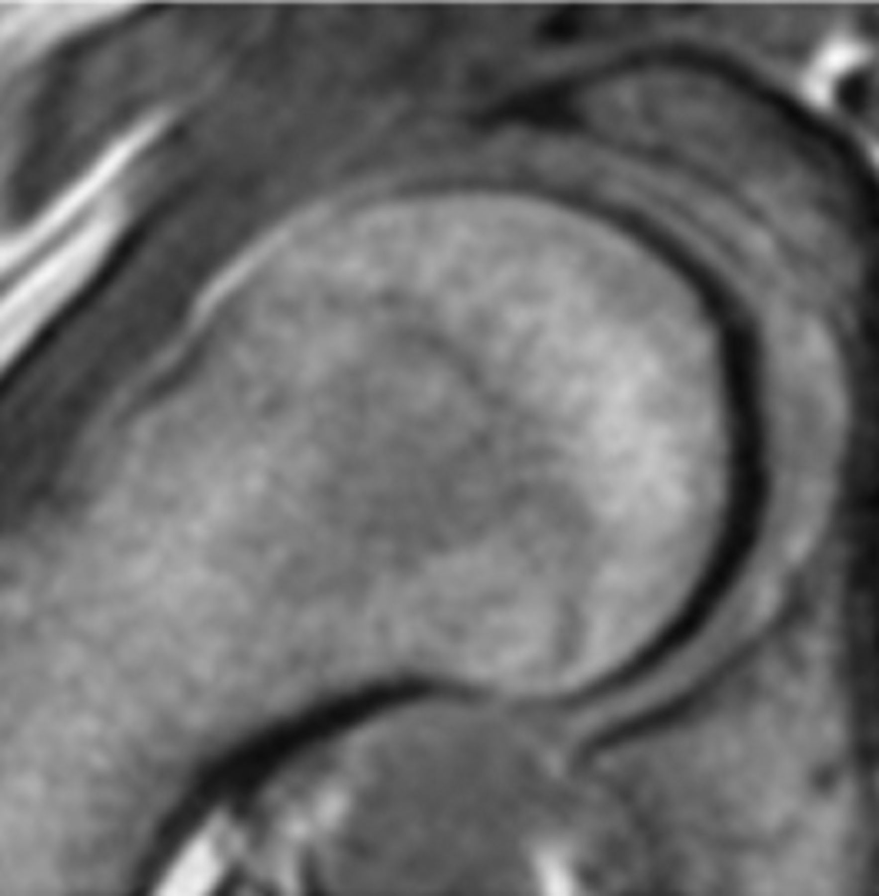 Figs. 2a - 2f 
          Representative MRI images
showing the six physeal grades in study subjects; a) grade 1, b)
grade 2, c) grade 3, d) grade 4, e) grade 5, and f) grade 6.
        