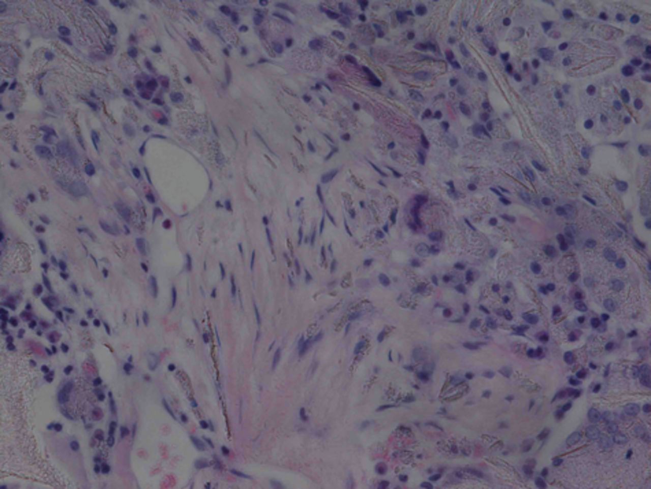 Figs. 10a - 10d 
          Histological observation
in the experimental group 24 weeks post-operatively, observed using
an optical microscope, showing a) cells arranged in a disorderly manner:
the scaffold has degraded (Haematoxylin-eosin staining, × 400),
b) cells arranged in a disorderly manner, the scaffold has degraded
(Alcian blue, × 400), c) the scaffold has mostly degraded, type
II collagen in chondrocyte plasma and extracellular matrix is stained
a browny-yellow colour (Immunohistochemistry, × 100) and d) the
upper layer (red) is cartilage matrix, the middle is the osteochondral
interface, and the tidal line is unclear (Safranin O staining, ×40).
        