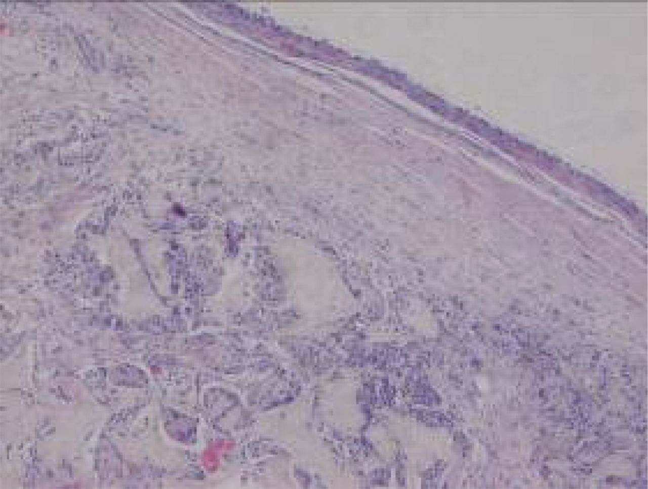 Figs. 8a - 8b 
          Haematoxylin-eosin staining in the
experimental group 12 weeks post-operatively, observed using an optical
microscope, which showed that a) the surface is smooth, and many
inflammatory cells can be seen in the scaffold (× 100) and b) cells
are arranged in a disorderly fashion, and the majority of the scaffold
has degraded (× 400).
        