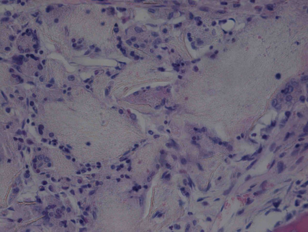 Figs. 8a - 8b 
          Haematoxylin-eosin staining in the
experimental group 12 weeks post-operatively, observed using an optical
microscope, which showed that a) the surface is smooth, and many
inflammatory cells can be seen in the scaffold (× 100) and b) cells
are arranged in a disorderly fashion, and the majority of the scaffold
has degraded (× 400).
        