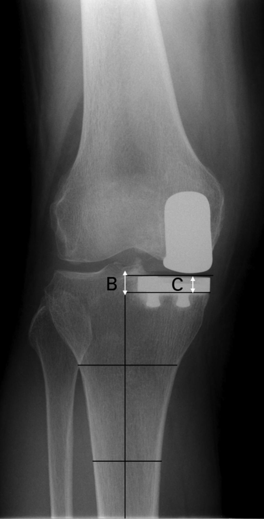 Figs. 1a - 1b 
            Pre-operative anteroposterior
radiographs showing a) the distance between the adductor tubercle
as the distal point on the medial condylar slope of the femur and
the joint line (line D) and b) the depth of resection was defined
as differences between distance A and distance B. Line C was the
thickness of the tibial insert used to correct magnification.
          