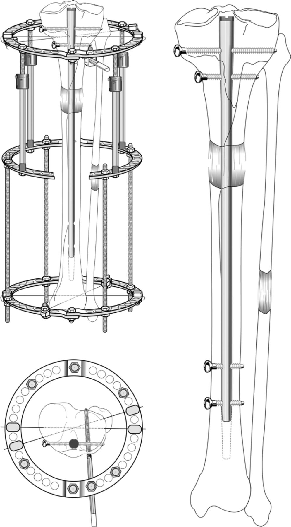 Fig. 1 
            Illustrations showing lengthening over a nail using a circular fixator. (top left) The osteotomy has been made and stabilised by the intramedullary rod, which is locked proximally. The Ilizarov frame requires only minimal fixation: two wires distally and two wires proximally plus a half-pin. It is important to transfix the fibula at each end either with wires or cortical bone screws. After gradual lengthening, the rod has risen up to the diaphyseal region; (bottom left) a bird’s eye view of the proximal fixation. The wires (one of which captures the fibular head) and the half-pin are carefully inserted under control of the image intensifier to ensure that there is no contact between them and the intramedullary rod or its locking screws. Alternatively, the proximal and distal tibiofibular joints can be captured with independent bone screws. (right) The distal two interlocking screws are inserted to prevent shortening and the frame can be removed, leaving the rod as an internal stent, protecting the newly formed bone from bending, fracture, and deformation. Partial weight bearing is essential until there is complete consolidation. If the fibular regenerate bone is not healed at the time of frame removal, a cortical bone screw should be first inserted to stabilise the distal syndesmosis. Failure to do so may result in proximal migration of the distal fibula and disruption of the mortise. (Copyright 2015, Rubin Institute for Advanced Orthopedics, Sinai Hospital of Baltimore).
          