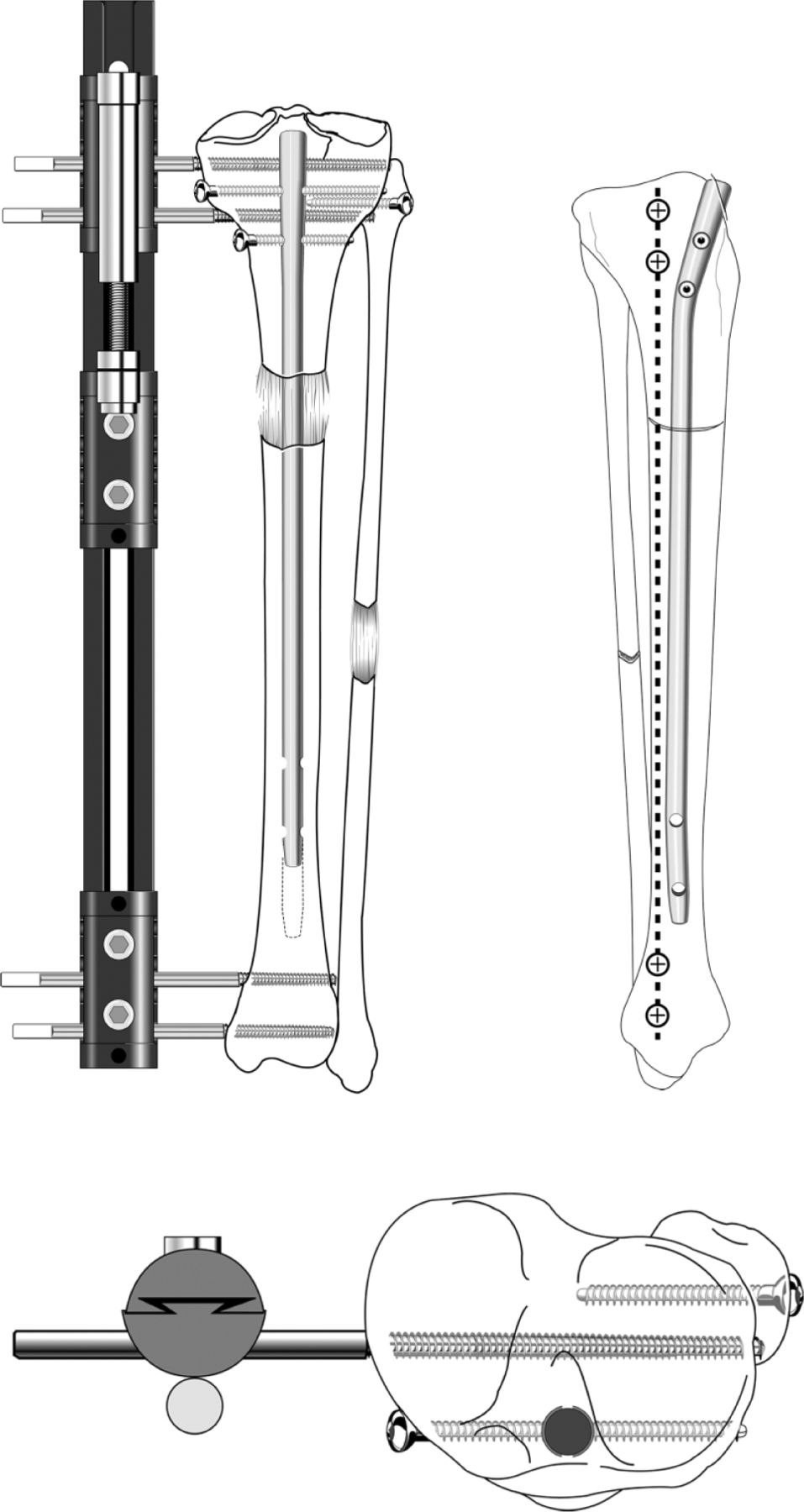 Fig. 2 
            Illustrations showing lengthening over a nail using a monolateral fixator. (top left) The nail is locked proximally. The proximal tibiofibular joint is captured by an independent bone screw. The distal tibiofibular joint is captured by a 4.5 mm cortical bone screw. During lengthening, the nail rises up. At the end of lengthening, the nail is locked distally. After frame removal, the newly formed bone matures under protection of the intramedullary rod; (bottom left) a bird’s eye view of the monolateral fixator slightly posterior to the intramedullary nail. The proximal fibula is transfixed with an independent screw; (right) a sagittal view of the tibial bone showing the position of the intramedullary nail in relation to the external fixator pins before lengthening has started (copyright 2015, Rubin Institute for Advanced Orthopedics, Sinai Hospital of Baltimore).
          