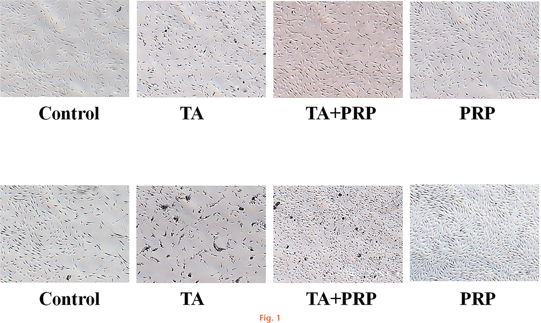 Fig. 1 
            Histological images showing cell morphology at day I (top) and day 3 (bottom), size bar 300 um (TA, triamcinolone acetonide; PRP, platelet-rich plasma)
          