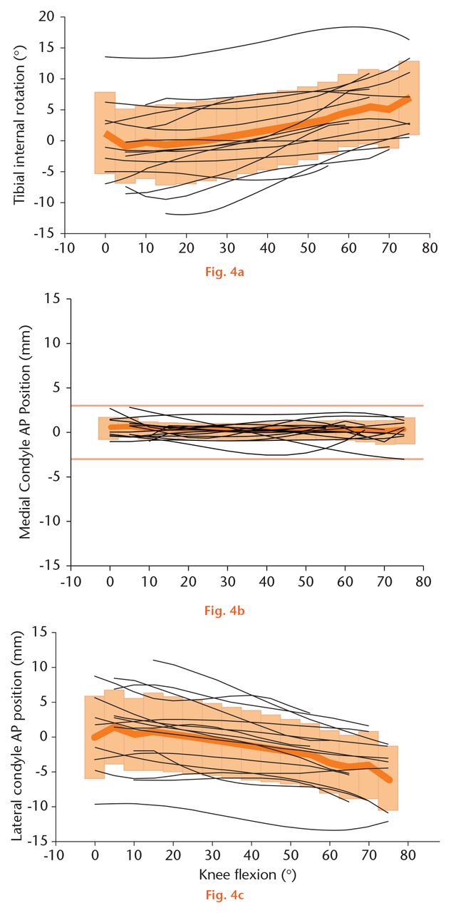  
            Knee kinematics during the step-up activity were characterised by little medial condylar translation with highly individual lateral condylar translation and tibial rotation. (a) Tibial internal rotation generally increased with flexion but this was highly individual. (b) There was very little medial condylar translation. (c) There was a mean 5 mm posterior translation of the lateral condyle but again it was highly individual. The thick orange line represents the mean for the group, and the shaded orange area represents one standard deviation. The thin black lines represent the individual data for each knee. (AP, anteroposterior)
          