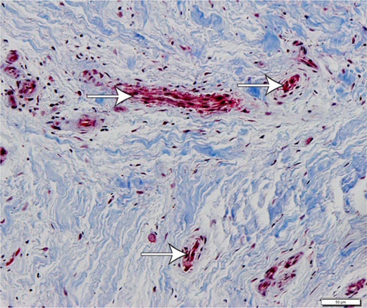 Fig. 2 
            Light microscopy showing the highly vascular nature of the biomembrane. Arrows mark vasculature. (Masson trichrome stain; bar = 50 µm).
          