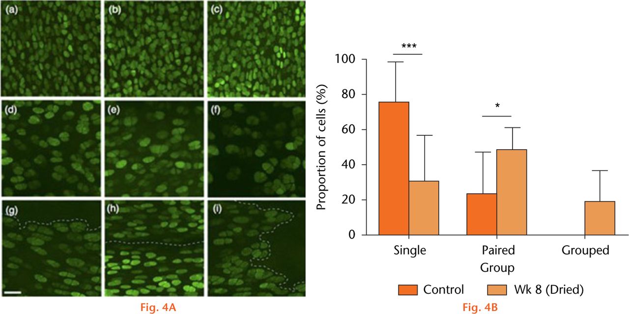  
            Chondrocyte morphology and distribution. (A(a–c)), examples of CLSM images from sham-operated joints, (d-f), cartilage in vivo dried (60 minutes), then visualised after eight weeks in regions that were distant from, and (g-i) at fibrillated areas (broken lines). (Bar = 50 µm). (B) The proportion of chondrocytes either singly, in pairs, or in groups/clusters in sham-operated cartilage, or after drying and eight weeks post-surgery. Data are means ± 95% confidence intervals. (Control three joints; 870 cells), week 8 (four joints; 1702 cells). (Asterisks denote significance levels; *p < 0.05, **p < 0.01, ***p < 0.001).
          