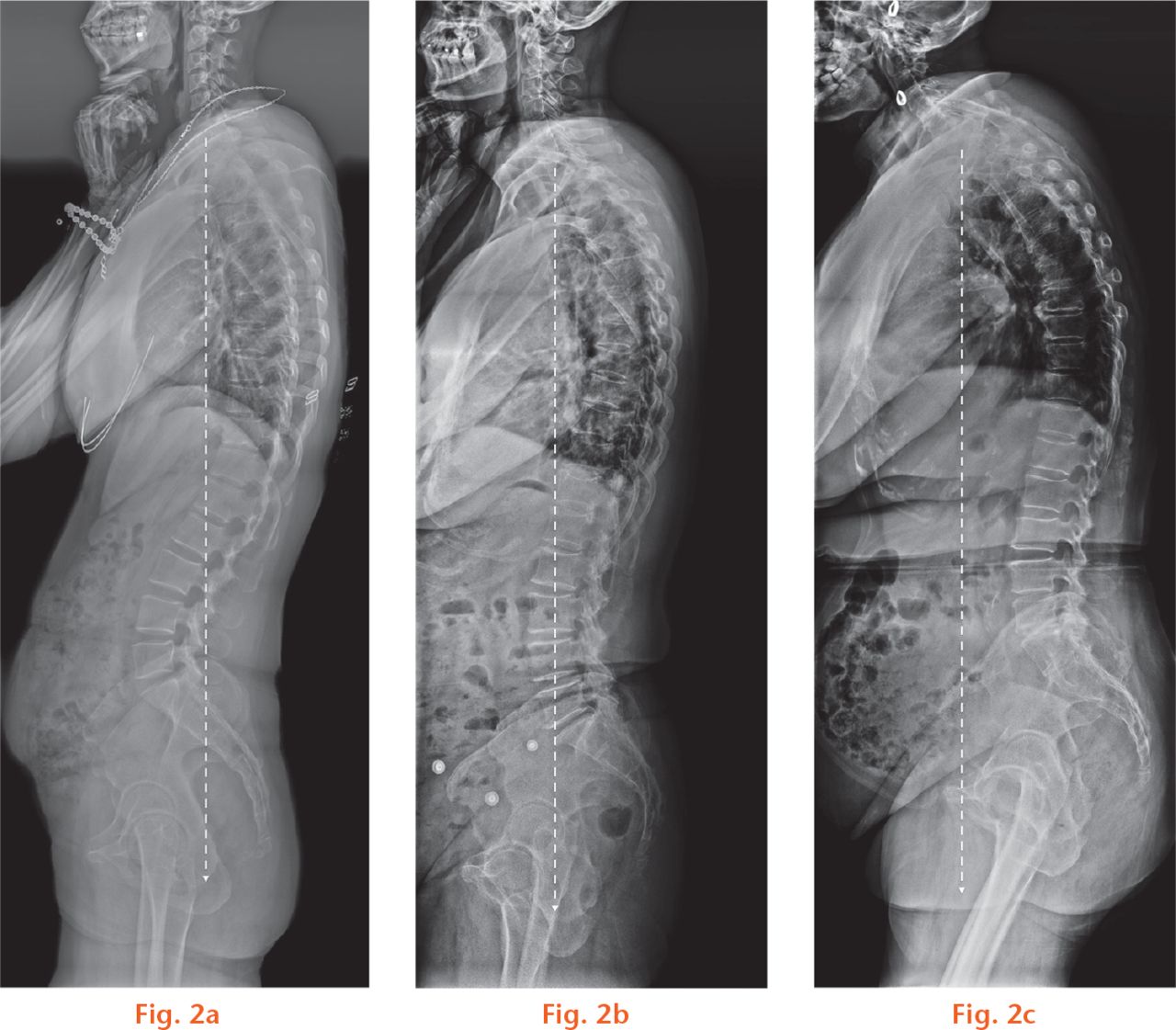  
            The sagittal balance pattern of spinopelvic alignment: a) normal balance, with slight pelvic retroversion and the C7 plumb line over the sacral end plate; b) slight unbalance, the C7 plumb line was located between the sacrum and femoral heads; c) severe unbalance, the C7 plumb line was located in the anterior of the femoral heads.
          