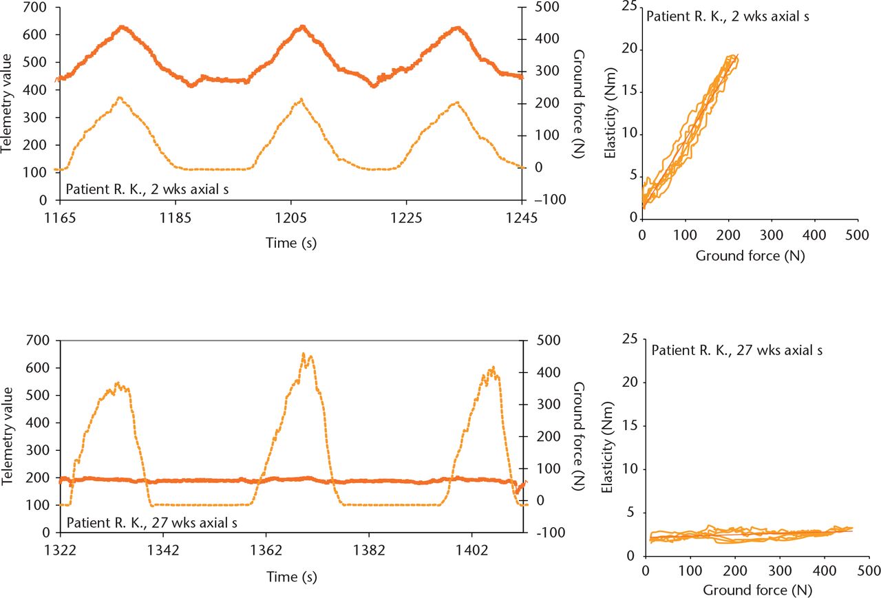 Fig. 1 
          Original recordings of externally applied load (dotted line) and telemetrically measurement implant load (solid line). Two weeks post-operatively (upper left), high implant loads were measured; the implant load was nearly gone by 27 weeks (lower left). Each measurement consisted of three cycles of increasing and decreasing external load. The corresponding slope of the regression line between externally applied load and measured fixator loads (upper and lower right) was calculated as the parameter of bone healing.
        