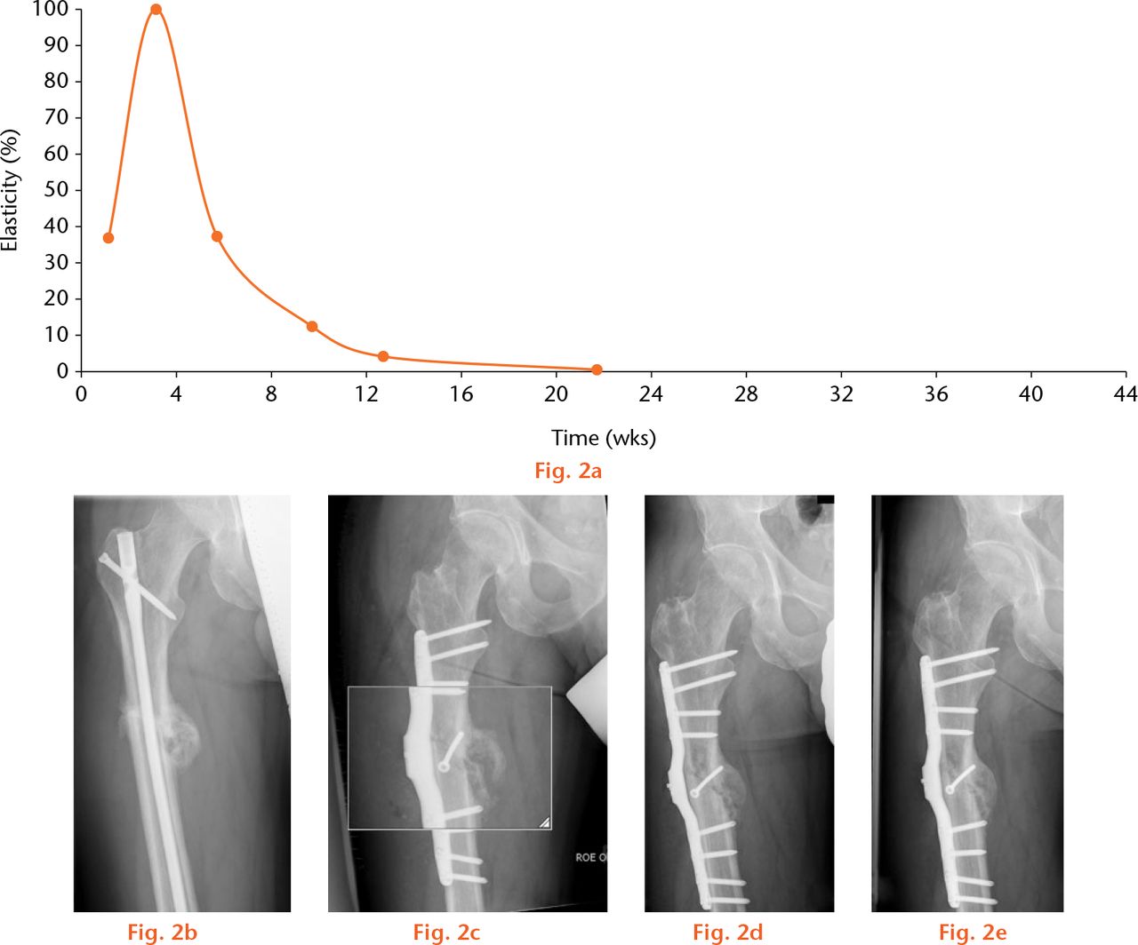  
          Example of a fast healing nonunion. A 47-year-old patient was treated with the instrumented internal fixator for a delayed union, combined with a 17° internal torsional deformity six months after primary osteosynthesis with an unreamed nail and three months after dynamisation. In this graph, (a) the curve of the telemetrically measured elasticity of the osteosynthesis, anteroposterior radiographs (b) pre-operatively with a nail inserted, (c) immediately post-operatively, (d) five weeks post-operatively and (e) nine weeks post-operatively are shown. In this patient, a lag screw was applied, resulting in a high initial stability (low elasticity) which diminished at four weeks.
        