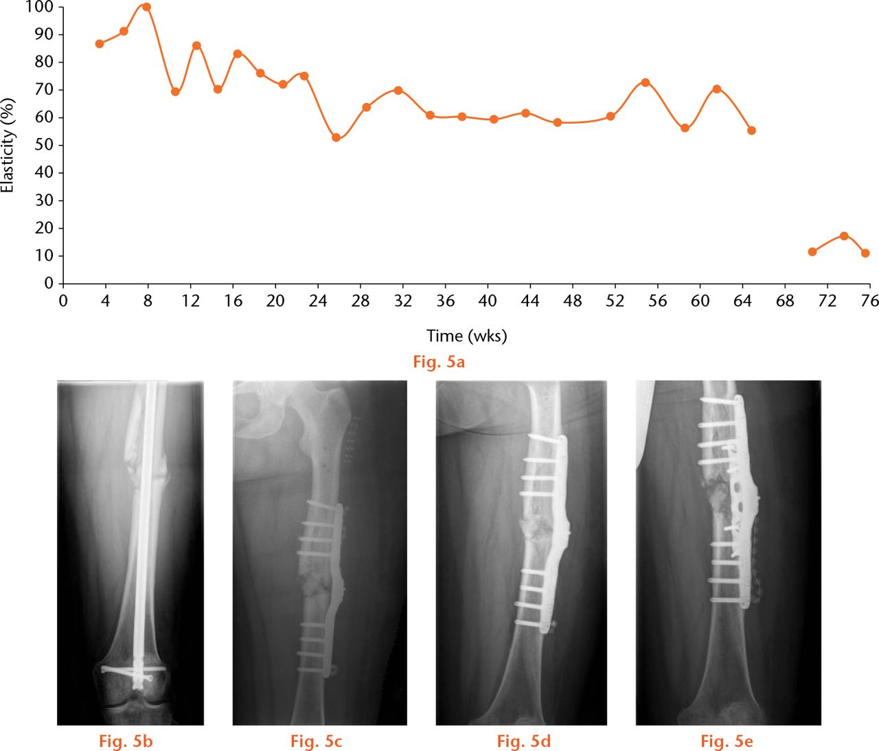  
          Example of a non-healing nonunion. A 50-year-old patient was treated with the instrumented internal fixator for a nonunion eight months after a polytrauma with primary osteosynthesis with an unreamed nail and four months after dynamisation. In this graph, (a) the curve of the telemetrically measured elasticity of the osteosynthesis anteroposterior radiographs (b) pre-operatively with a nail inserted, (c) immediately post-operatively, and (d) 64 weeks post-operatively are shown. A revision was performed applying a cancellous bone graft and an additional plate (e) resulting in a significant decrease in elasticity.
        