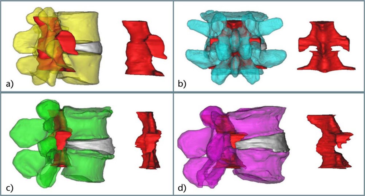 Fig. 3 
          Spinal canal volume in L4-L5 models: a) control; b) central canal stenosis; c) lateral recess stenosis; d) foraminal stenosis.
        