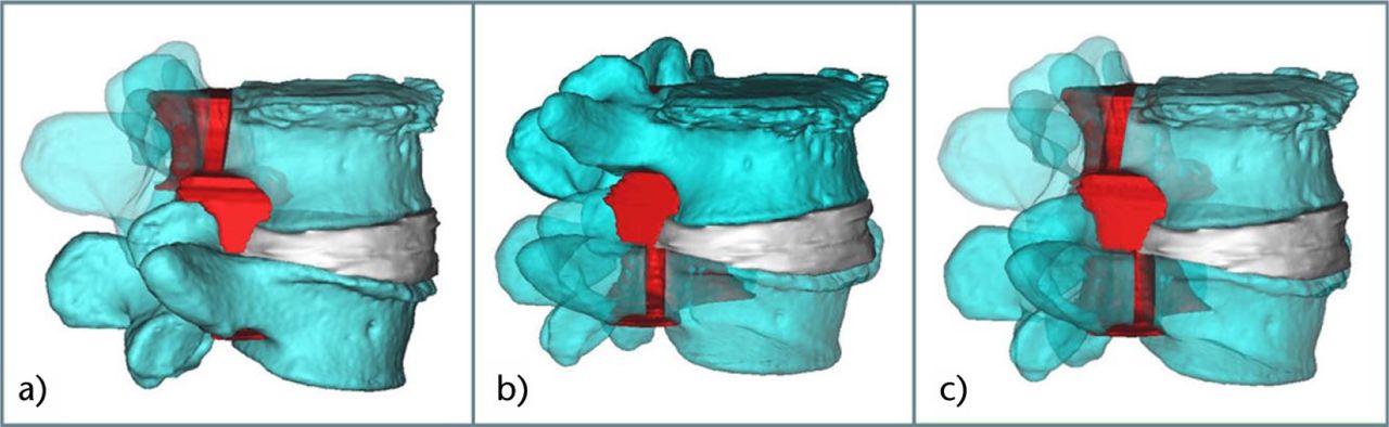 Fig. 5 
          Spinal canal volume after simulated pedicle-lengthening at L4 and/or L5: a) pedicle-lengthening at L4; b) pedicle-lengthening at L5; c) pedicle-lengthening at L4 and L5.
        