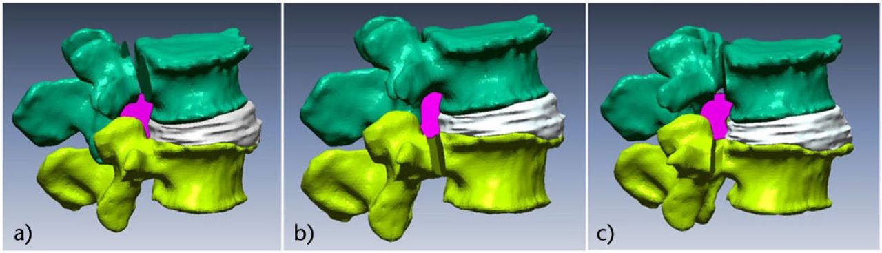 Fig. 6 
          Neural foraminal dimensions after simulated pedicle-lengthening at L4 and/or L5 levels: a) pedicle-lengthening at L4; b) pedicle-lengthening at L5; c) pedicle-lengthening at L4 and L5.
        