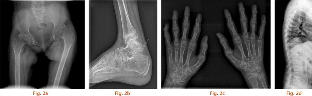  
          Radiographs showing a) the pelvis of an 11-year-old girl showing lateralisation of the femoral head on the left side. There is altered growth on the capital femoral physis and flexion deformity. The hip protrusio is not seen, which distinguishes PPD from juvenile rheumatoid arthritis; b) the ankle of a nine-year-old boy shows near fusion of the enlarged posterior process of talus. Normal fusion of posterior process of the talus in boys usually occurs after 11 years; c) hand of an 11-year-old girl showing metaphyseal widening and epiphyseal shortening most prominent in the proximal interphalangeal joints and flexion deformity of the distal interphalangeal joint of the 5th digit, with an enlarged soft-tissue shadow with loss of joint space. The ulnar styloid process is hooked like a parrot’s beak in this child. The distal radial physis is flattened and the wrist joint is irregular; d) spine of 12-year-old girl showing platyspondyly with inferior and central beaking. There is a grade I L5-S1 spondylolisthesis. The lumbar vertebrae show inferior, and thoracic vertebrae show central, beaking.
        