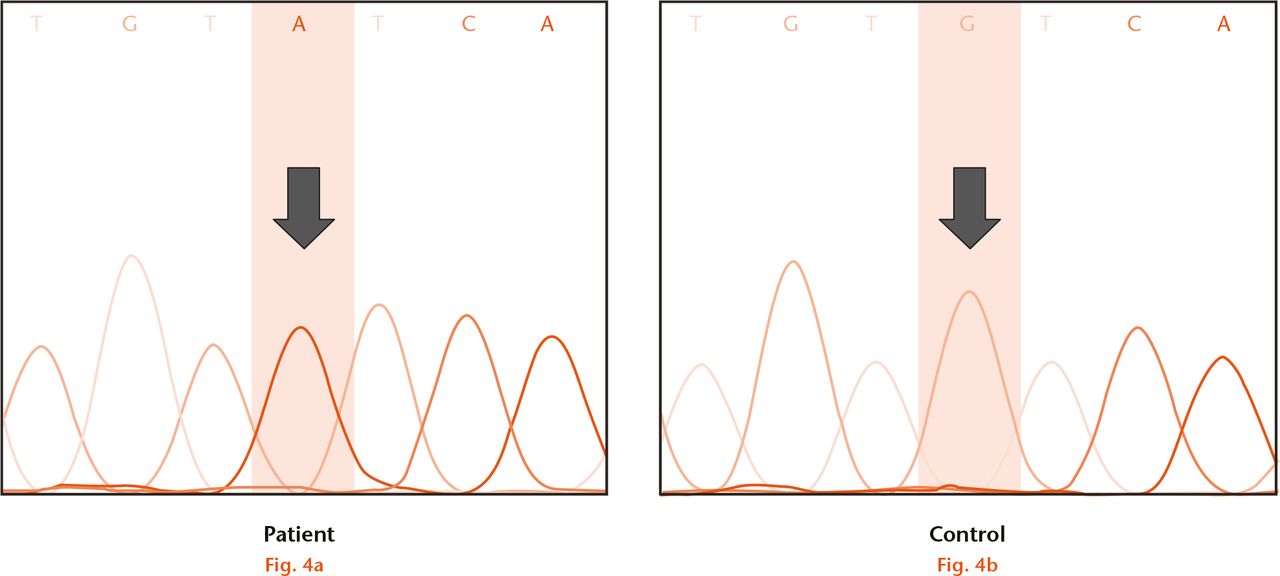  
          Direct sequencing of fifth exon of the WISP3 gene in the fourth patient; (a) showed the presence of homozygous missense mutation c.1010G>A (p.C337Y) when compared with (b) control.
        