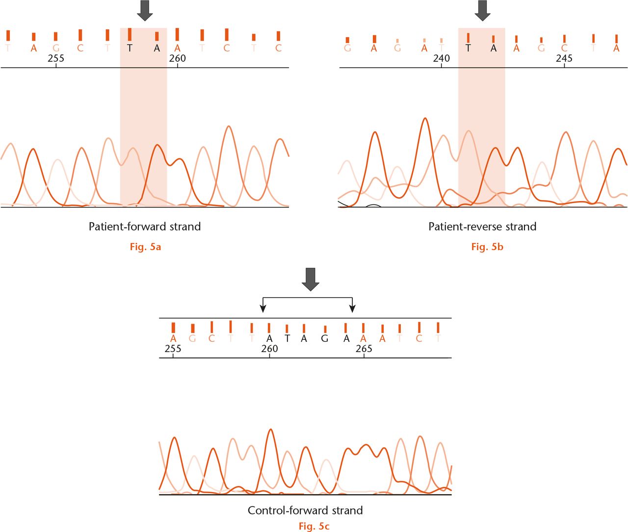  
          Direct sequencing of fourth exon of the WISP 3 gene in the fifteenth patient shows (a) the absence of ATAGA sequence (black arrow) in the forward strand, indicating a deletion mutation c. 593_597delATAGA (p.Y198*); b) confirmation of this mutation was obtained by sequencing the reverse strand and; c) normal ATAGA sequence was seen in the control sample (black arrow).
        