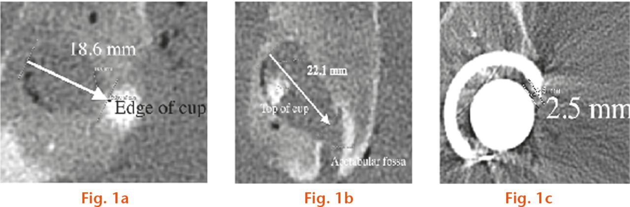  
          Measurement of periacetabular osteolysis (PAO) and wear. On the left side (image) the ‘osteolysis’ was connected to the acetabular central grove which made it difficult to define where the osteolysis began; a) PAO, left side depth; b) PAO, right side width.; c) wear on left side. The shortest distance between inner border of the component and head was measured.
        