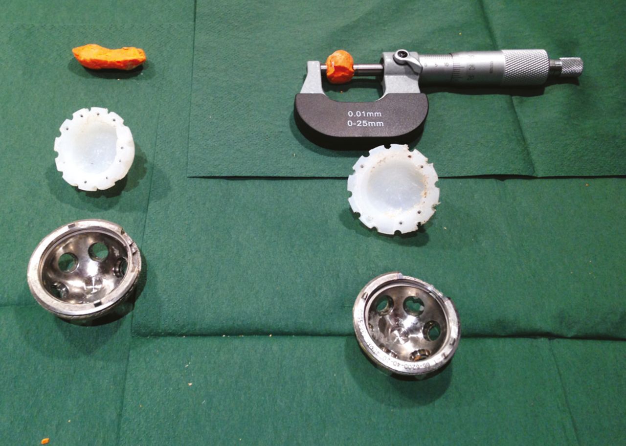 Fig. 2 
          Actual drilled depth and width measured from a plastic mould using a micrometer for the man-made periacetabular osteolysis. Drilled wear measured with a micrometer.
        