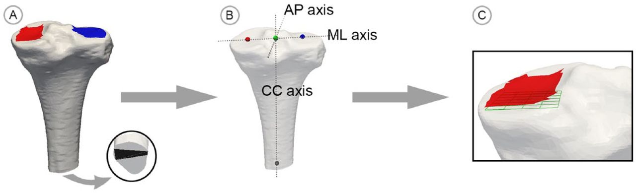 Fig. 2 
            Illustration of the grid construction process; a) three tibia surfaces areas are selected by the user; b) the geometric means of these locations are used to define the coordinate system; c) the measurement grid is constructed beneath the medial condylar surface area aligned with the coordinate system.
          