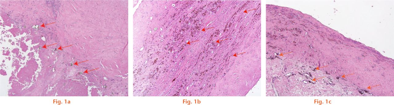  
            Histological images showing a) a low-power photomicrograph representing a score of 3 for green shards found within the tissue. The tissue section illustrates an abundance of green shards indicated by blue arrows within the section; b) a low-power photomicrograph representing a score of 3 for brown/red coloured corrosion particles found within the tissue. The tissue section illustrates an abundance of brown/red coloured corrosion particles indicated by blue arrows within the section; and c) a low-power photomicrograph representing a score of 3 for brown/black coloured corrosion particles found within the tissue. The tissue section illustrates an abundance of brown/black coloured corrosion particles indicated by blue arrows within the section.
          