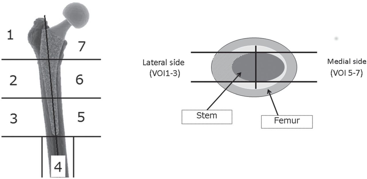 Fig. 1 
          Segmentation of the finite element models of the femur (a) in the coronal plane according to Gruen’s zones,14 and (b) in the horizontal plane to create seven volumes of interest (VOIs).
        