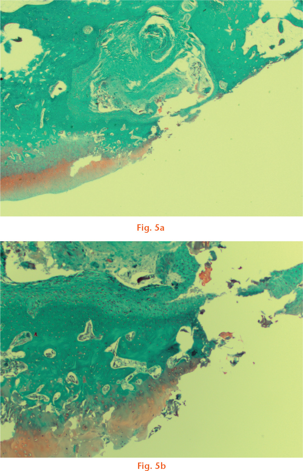  
          Cartilage samples (1.25× above, 4× below) from an animal undergoing Mayo contracture model surgery and collagen scaffold placement, demonstrating changes greater than those due to artefact.
        