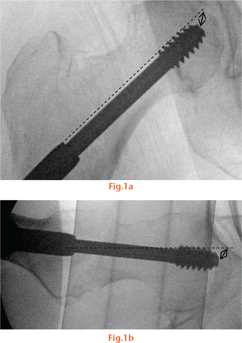  
          Intra-operative radiographs showing measurement of the tip-apex distance for SHS in antero-posterior (a) and lateral (b) views. The apex of femoral head was defined as the intersection of the central axis of the femoral neck (dashed line) with subchondral bone. Double headed arrows showing tip-apex measurement.
        