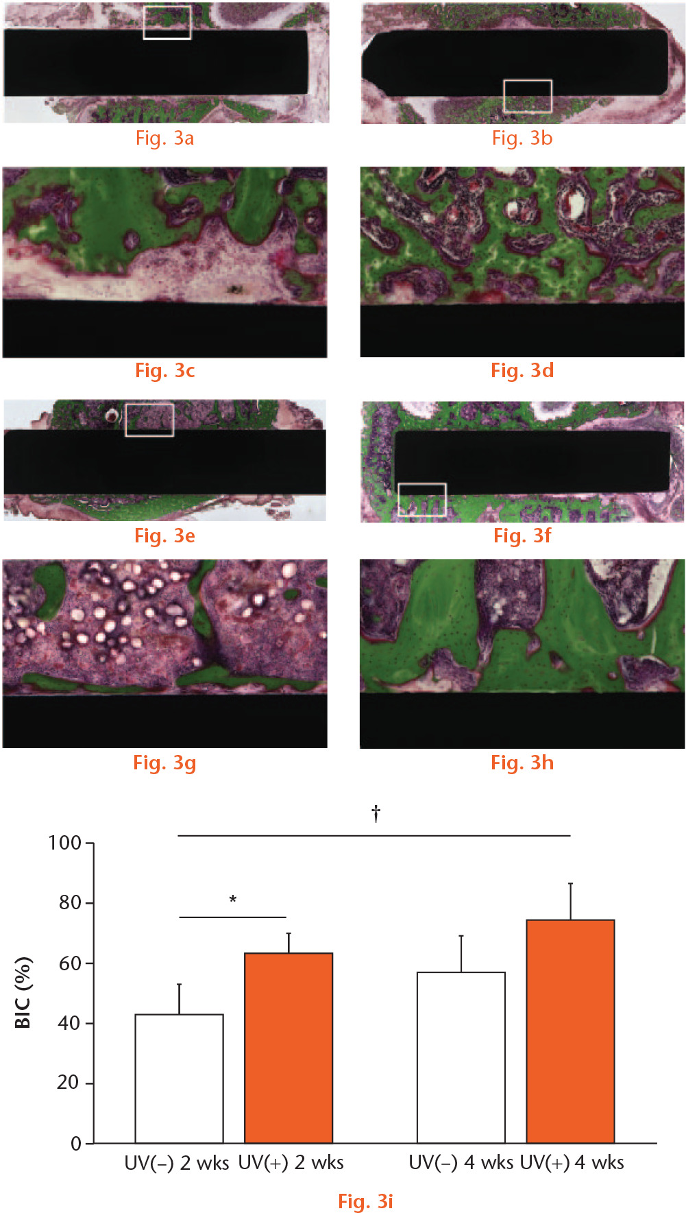  
            Light microscope images (magnification ×4 and ×10, higher magnification images of the boxed areas) two and four weeks after the implantation. The micrographs show the bone response for the (A, C, E, G) Ti(−) and (B, D, F, H) Ti(+) implants. Scale bar: 200 μm. (I) BIC ratios for Ti(−) and Ti(+) were calculated. Results are shown as mean percentage ± standard deviation. p < 0.05, *Ti(−) vs Ti(+), **2 vs 4 w, †Ti(−) 2 w vs Ti(+) 4 w (n = 5).
          