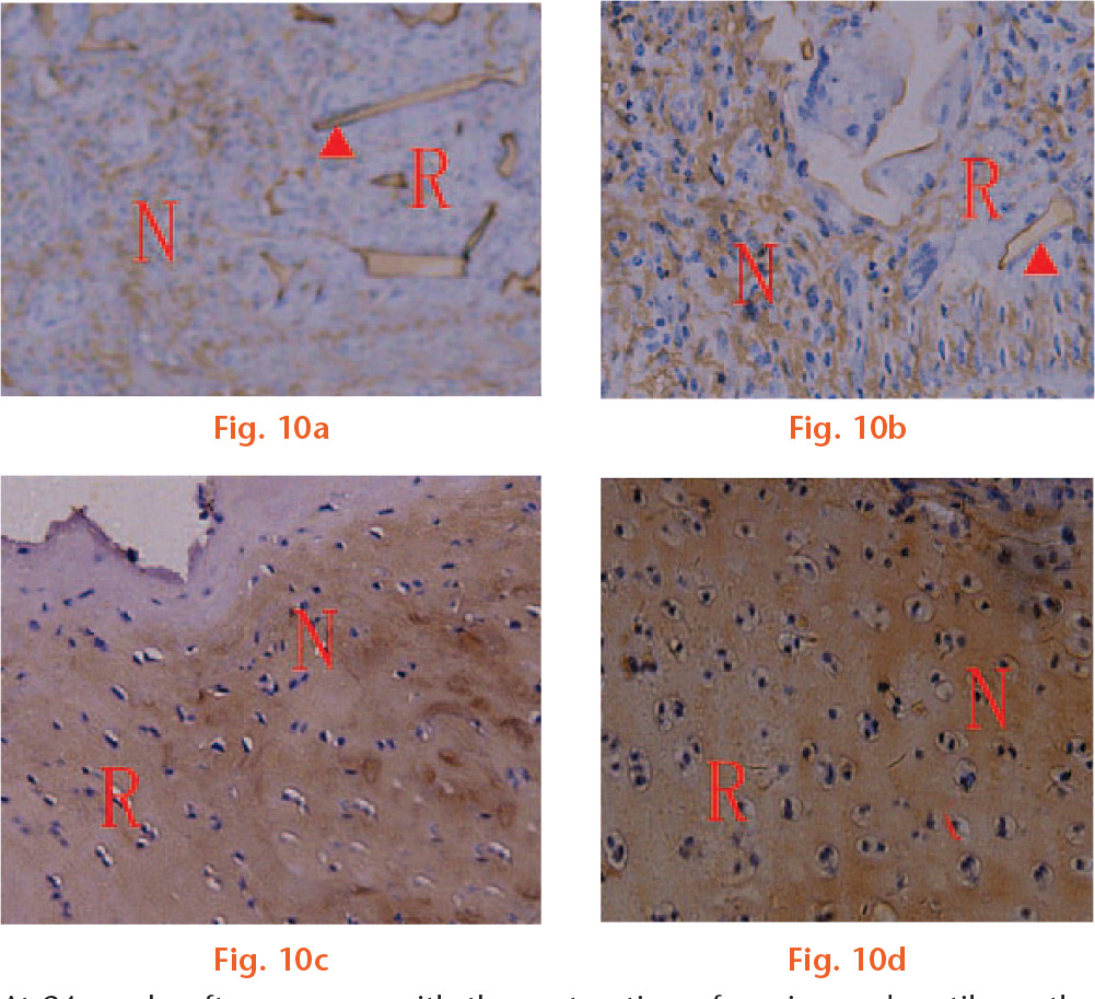  
            At 24 weeks after surgery, with the maturation of engineered cartilage, the expression and distribution of COL II in the c) CBA and d) auto groups were similar to those of normal cartilage, with positive staining of the ECM matrix around the evenly distributed chondrocyte-like cells at the site of the repair tissue. Most of the scaffolds in the CBA group were degraded, endocytosed, and replaced. The BA group b) had better results than the control group a) but worse results than the CBA group. ▲: traces of the scaffold; R, regenerated tissue; N: normal tissue.
          