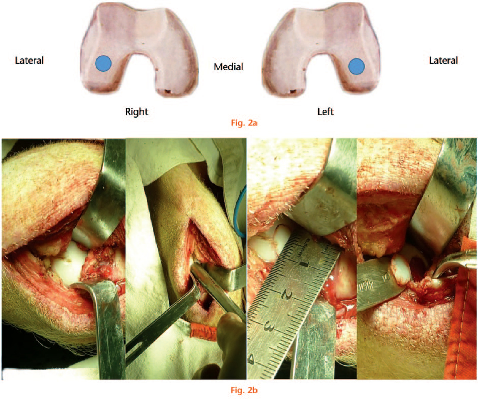  
            a) Schematic image showing the location of the cartilage defects on the load-bearing region of the lateral femoral condyle; b) the surgical approach showing location of cartilage defects on the lateral femoral condyle.
          