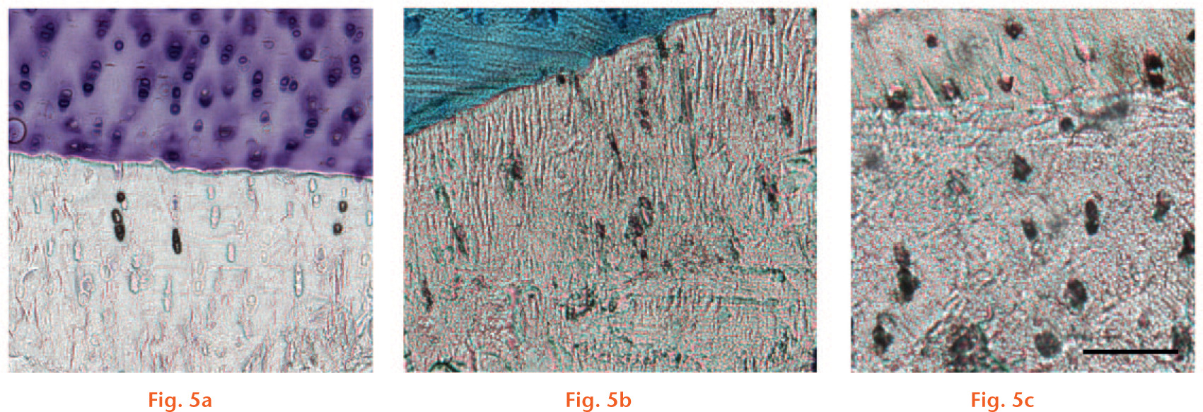  
            Representative photomicrographs of immunohistochemistry in osteocytes in the subchondral bone: a) MMP-13, b) cathepsin K, and c) HTrA1. Osteocytes stained positively are seen as black cells in the fractured samples. In a), the cartilage is stained with toluidine blue; in b), the cartilage is stained with methyl green. Scale bar 100 μm.
          