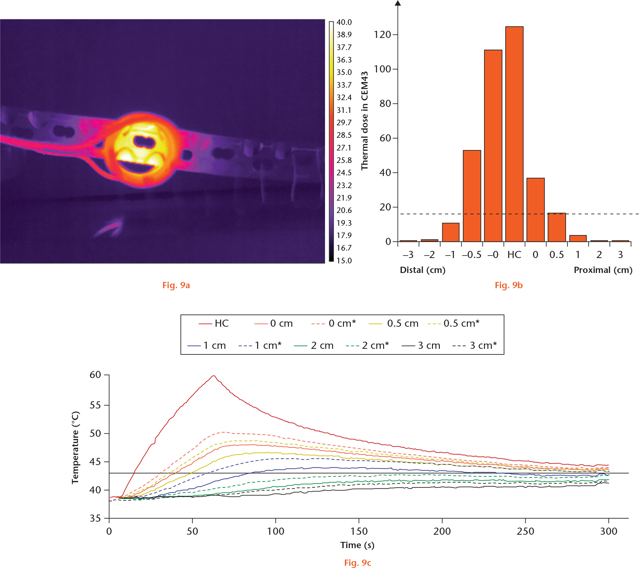  
            Segmental induction heating of locking compression plate (LCP), underside. a) A thermal image from a thermal camera showing selective heating. The vertical lines have 1 cm spacing. b) A graph showing thermal dose in CEM43 at several distances from the heating centre (HC). The dashed line represents 16 CEM43, the threshold for necrosis of bone. c) A graph showing the temperature at several distances from the HC during the segmental induction heating and thereafter. Dashed lines indicate distal direction.
          