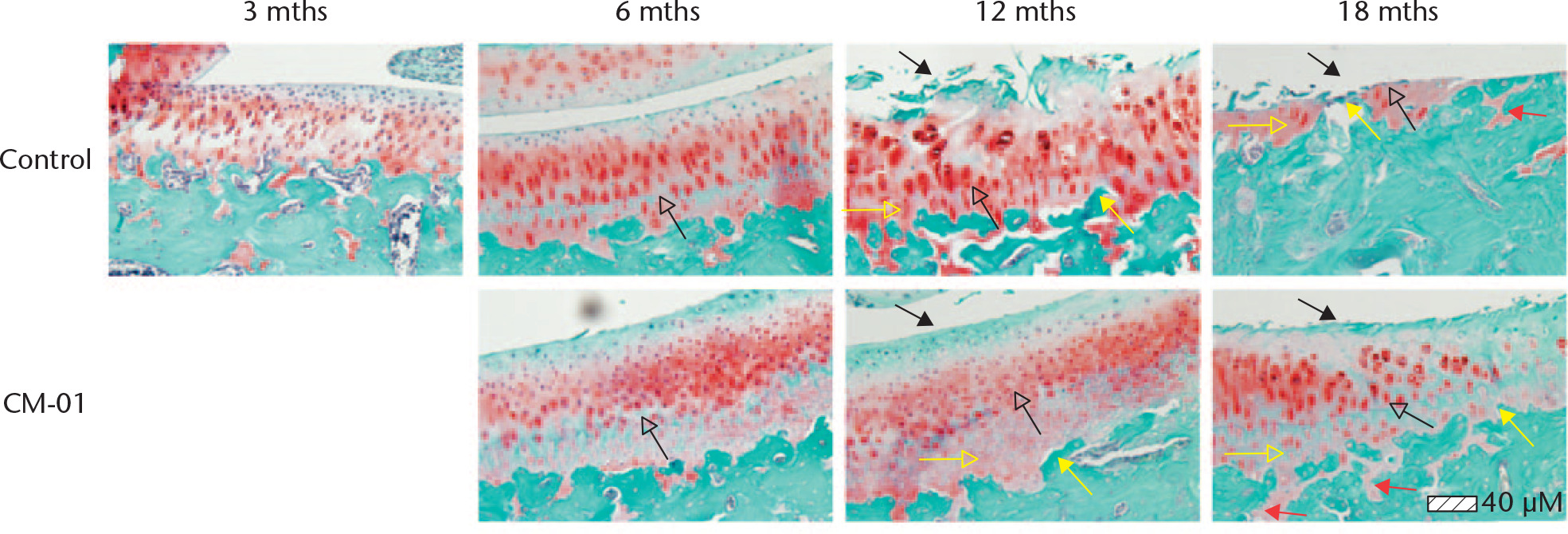 Fig. 2 
            Safranin-O-stained sections of medial tibial plateaus. Solid black arrows, the central most degenerated area; hollow black arrows, tidemarks; solid yellow arrows, uppermost front of subchondral bone; hollow yellow arrows, calcified zone cartilage; red arrows, articular cartilage bars or islands embedded within subchondral bone. CM-01, Carolinas Molecule-01.
          