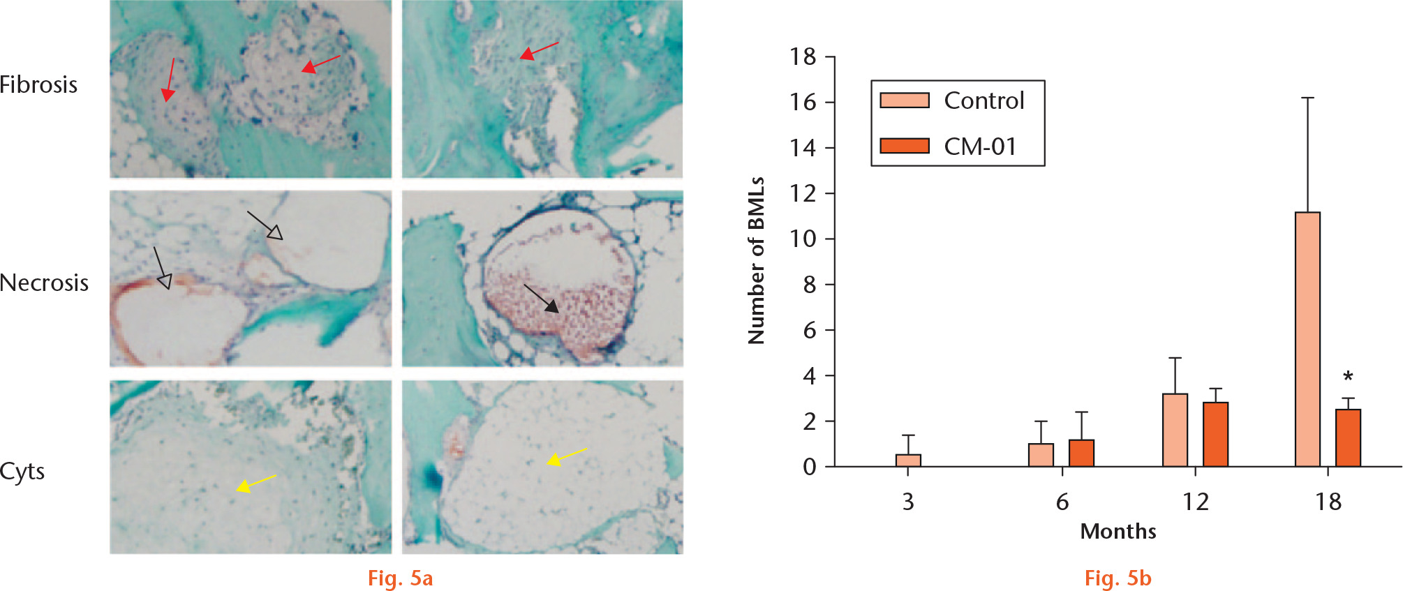  
            a) Three types of bone marrow lesions (BMLs) within the epiphysis: fibrosis, necrosis, and cysts. Fibrosis (fibrotic BMLs) was characterized by fibrotic tissues embedded within the bone marrow or subchondral bone (red arrows). Necrosis (necrotic BMLs) was characterized by an empty space (hollow black arrows) enclosed by a thin fibrotic membrane (stained green) or a fibrocartilaginous membrane (stained red). In some cases, small amounts of regenerated fibrocartilaginous tissues were present within the enclosed space (solid black arrow). Cysts were characterized by a space filled with gel-like substances (yellow arrows). b) Graph showing that the mean number of BMLs in the three-, six-, 12-, and 18-month-old guinea pigs were 0.5 (sd 0.87), 1 (sd 1), 3.17 (sd 1.61), and 11.17 (sd 5.01), respectively. The number of bone marrow lesions was significantly smaller in the 18-month-old Carolinas Molecule-01 (CM-01)-treated guinea pigs (2.50, sd 0.50) compared with the untreated control (11.17, sd 5.01). *p < 0.05, versus untreated control (Student’s t-test).
          