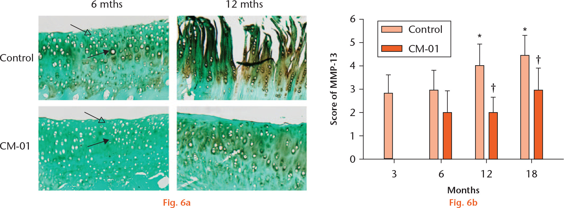  
            a) Immunostaining of matrix metalloproteinase-13 (MMP13) in the central area of the medial tibial plateau and immunostaining scores. Solid black arrows, middle and deep zones; hollow black arrows, superficial zone. b) Graph showing that mean immunostaining scores in the 12- and 18-month-old untreated guinea pigs, and in age-matched Carolinas Molecule-01 (CM-01)-treated guinea pigs, were 4.00 (sd 0.94), 4.45 (sd 0.86), 2.12 (sd 0.67), and 2.97 (sd 0.94), respectively. *p < 0.05, versus three-month old controls (one-way analysis of variance). †p < 0.05, versus age-matched untreated controls (Mann–Whitney U test).
          