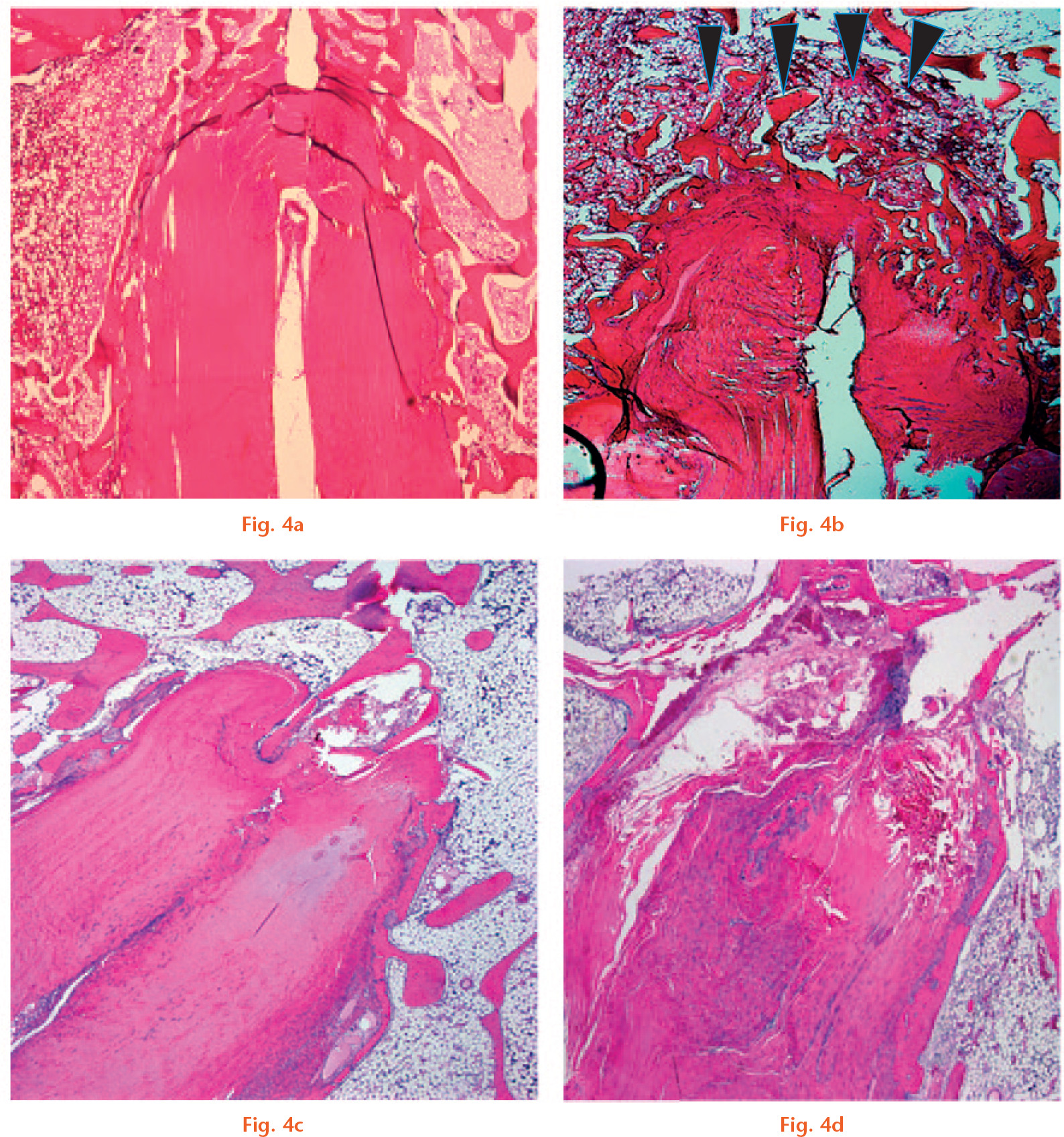  
            Representative photomicrographs of the tendon/bone interface with haematoxylin and eosin (H&E) staining (magnification × 25): a) specimen from the Socket group at four weeks; b) specimen from the Tunnel group at four weeks shows that new trabecular bone (arrowheads) has already covered the roof zone; c) specimen from the Socket group; and d) Tunnel group at eight weeks (scale bars, 1.0 mm).
          