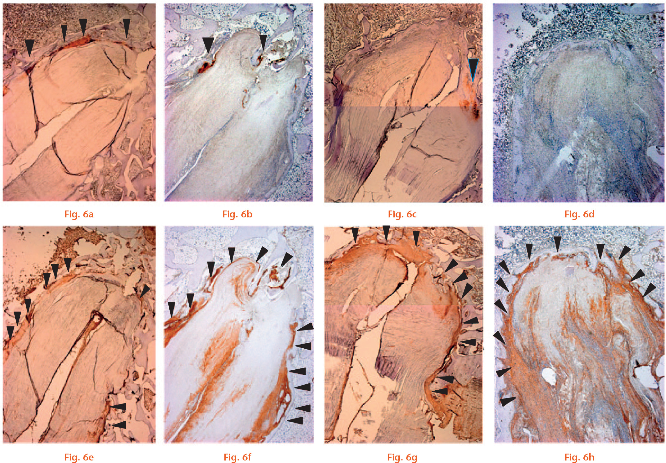  
            Photomicrographs of the tendon/bone interface with immunohistochemical staining for cartilage (type II collagen) (a-d) (magnification × 25). Cartilage tissue (arrowheads) was observed at four weeks in a) the Socket group and b) Tunnel group. At eight weeks, staining for cartilage was reduced in both the c) Socket group and d) Tunnel group. e-h) Photomicrographs of the tendon/bone interface with immunohistochemical staining for type III collagen (magnification × 25). Type III collagen (equivalent to Sharpey’s fibres; arrowheads) was primarily expressed at the tendon/bone interface at four weeks in the e) Socket and f) Tunnel groups. Staining was similar at eight weeks in the g) Socket and h) Tunnel groups (scale bars, 1.0 mm).
          