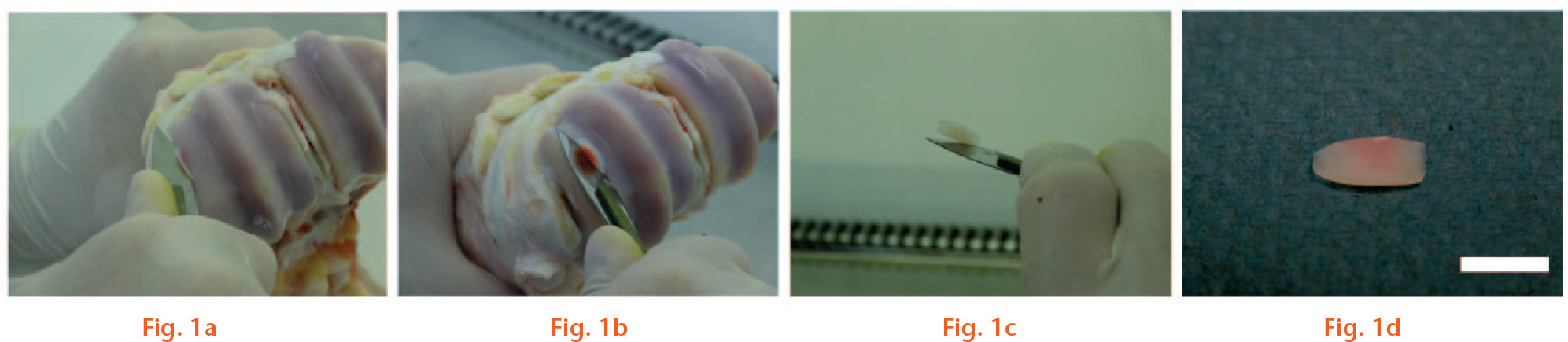  
            Photographs showing osteochondral explant harvesting from the bovine metacarpophalangeal joint: a) a sterile number-24 scalpel blade was used to acquire explants from the proximal limb; b) due to the convex nature of the number-24 scalpel blade, a steady forward and backward ‘rocking’ movement of the blade yielded explants with approximately 0.5 mm subchondral bone attached; c) the explants were immediately transferred to a vessel containing sterile Dulbecco’s Modified Eagle’s Medium using the harvesting blade i.e. a ‘no touch’ technique; d) an example of a typical oval explant (scale bar = 1 cm).
          