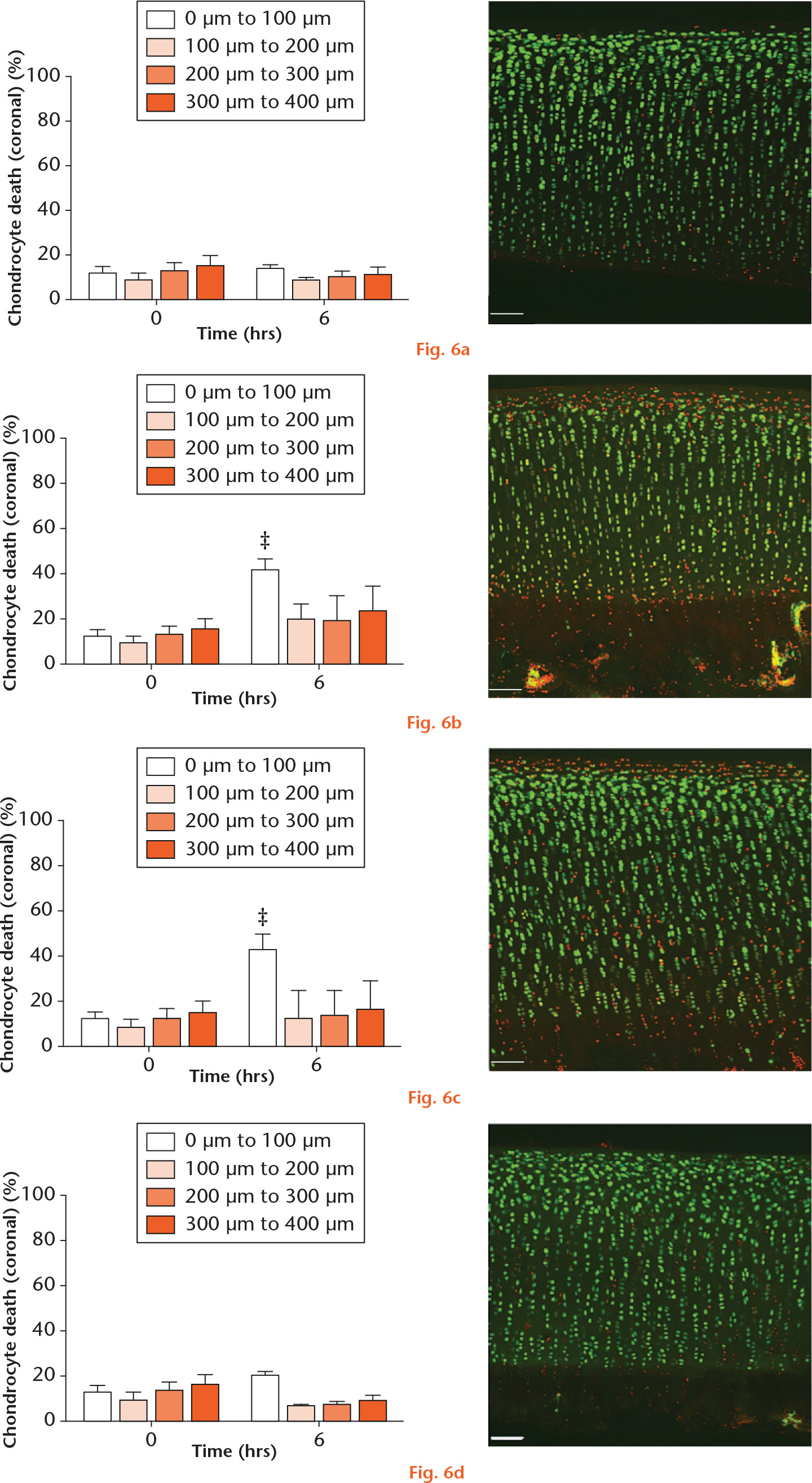  
            Graphs showing the pattern of alpha-haemolysin-induced chondrocyte death. Over 40 hours, compared with the a) Hla-Hlb-Hlg- control group, there was significantly more chondrocyte death within the first 100 µm of explants exposed to the b) Hla-containing 8325-4 and c) Hla+Hlb-Hlg- supernatants. d) There was no change in chondrocyte viability in explants exposed to the Hla-Hlb+Hlg+ strain supernatant (N = 4 (n = 8); ‡p < 0.001 vs Hla-Hlb-Hlg- strain supernatant by post hoc Dunnett’s test). a) to d) The confocal laser-scanning microscopy inserts show examples of the zonal pattern of chondrocyte death following explant exposure to the 40-hour culture supernatant of the strain indicated.
          