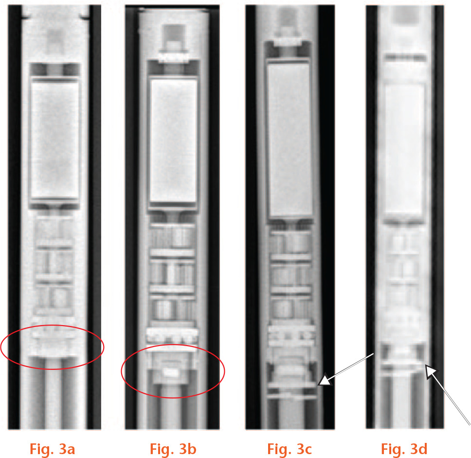  
            Plain radiographs of different internal mechanisms in retrieved Precice nails. a) Radiograph of early P1 design, with a longer frame compared with the rest of the designs. b) Radiograph of the later P1 design with a smaller frame. c) Radiograph of P2 design with an arrow showing the metal rings close to the actuator pin. d) Radiograph of P2.1 design with an arrow showing the metal rings.
          