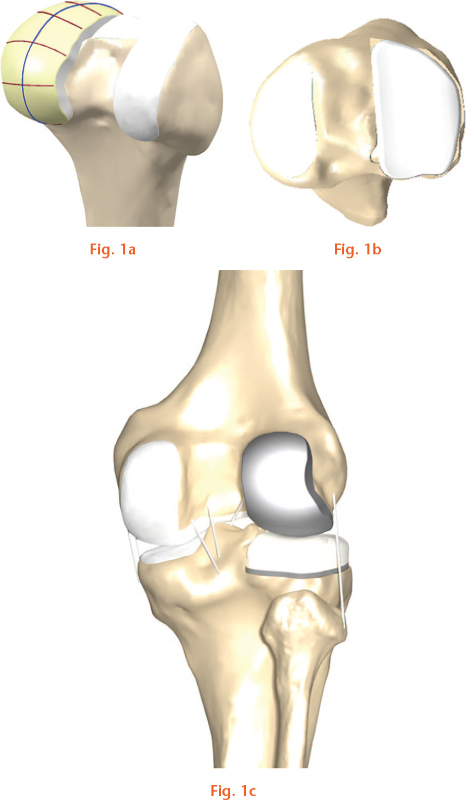 Fig. 1 
            Design process of patient-specific (PS) unicompartmental knee: a) spline curves used to model the femoral component; b) polyethylene insert that provides an anatomical fit and perfect coverage; and c) PS unicompartmental knee arthroplasty (UKA) model design.
          