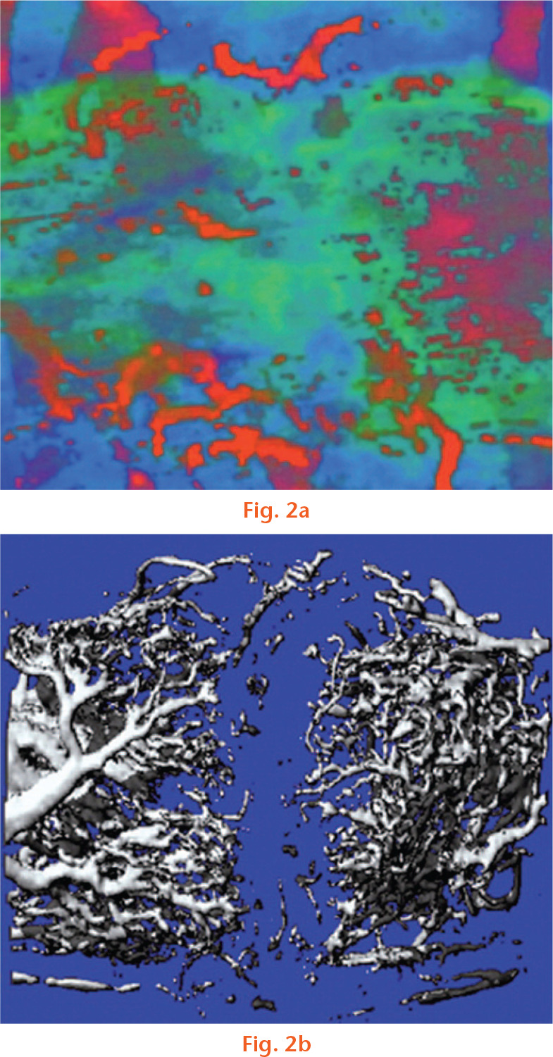 Fig. 2 
            3D reconstruction of a) power Doppler and b) microangiography CT. Reproduced with permission from Sun MH, Leung KS, Zheng YP, et al. Three-dimensional high frequency power Doppler ultrasonography for the assessment of microvasculature during fracture healing in a rat model. J Orthop Res 2012;30:137-143.
          