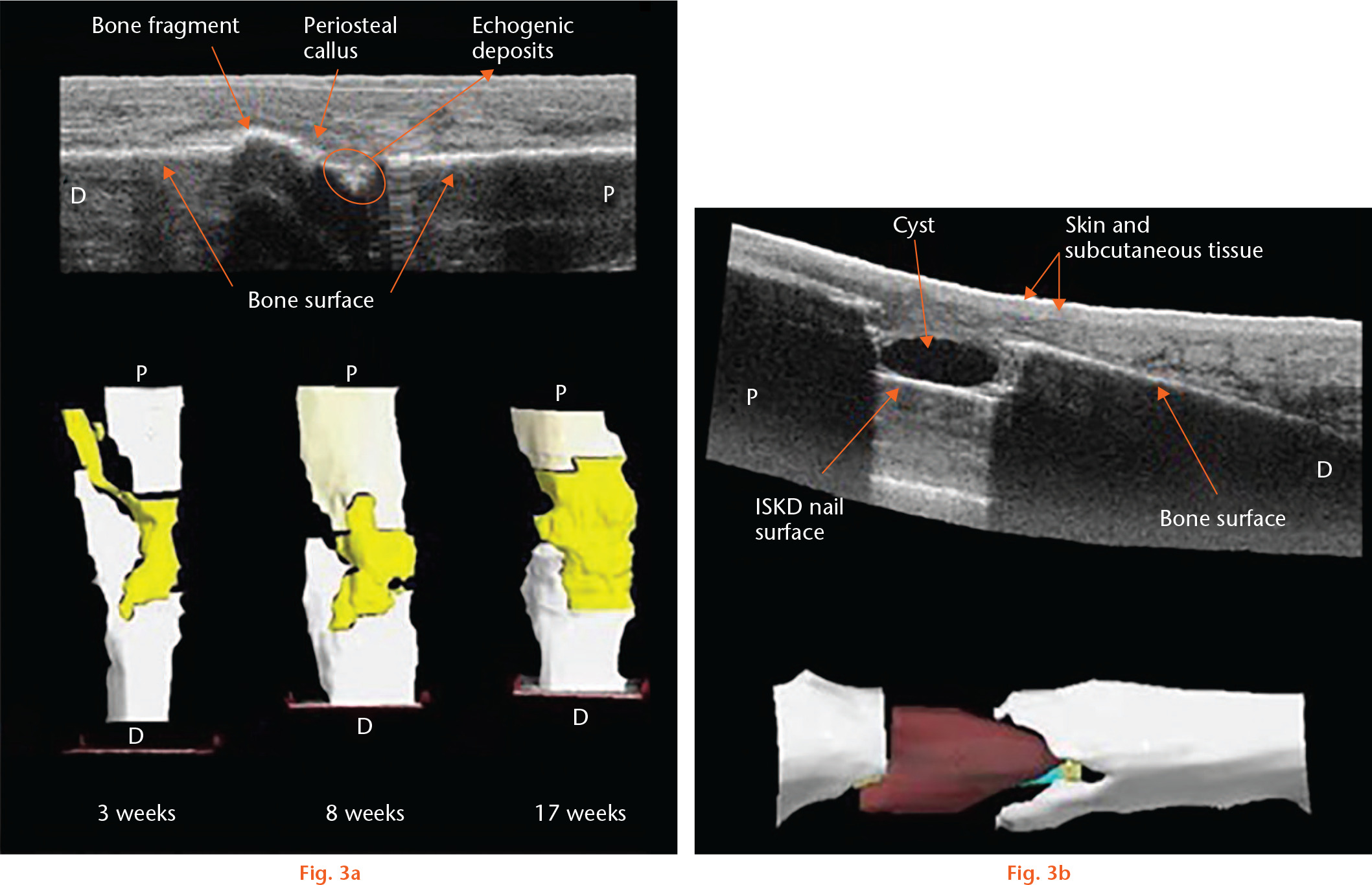 Fig. 3 
            a) Reconstruction following tibia shaft nailing. 2D reconstruction shows consolidating callus formation and 3D reconstruction shows the bridging callus from an early stage.54 b) Patient with an intramedullary skeletal kinetic distractor (ISKD) nail in situ at eight weeks following distraction osteogenesis. 2D view and 3D view presented with a cyst (red) detected at the distraction site.54 Reproduced with permission from Ross E. Freehand three dimensional ultrasound for imaging components of the musculoskeletal system. Edinburgh Research Archive. 2010. https://www.era.lib.ed.ac.uk/handle/1842/4500.
          