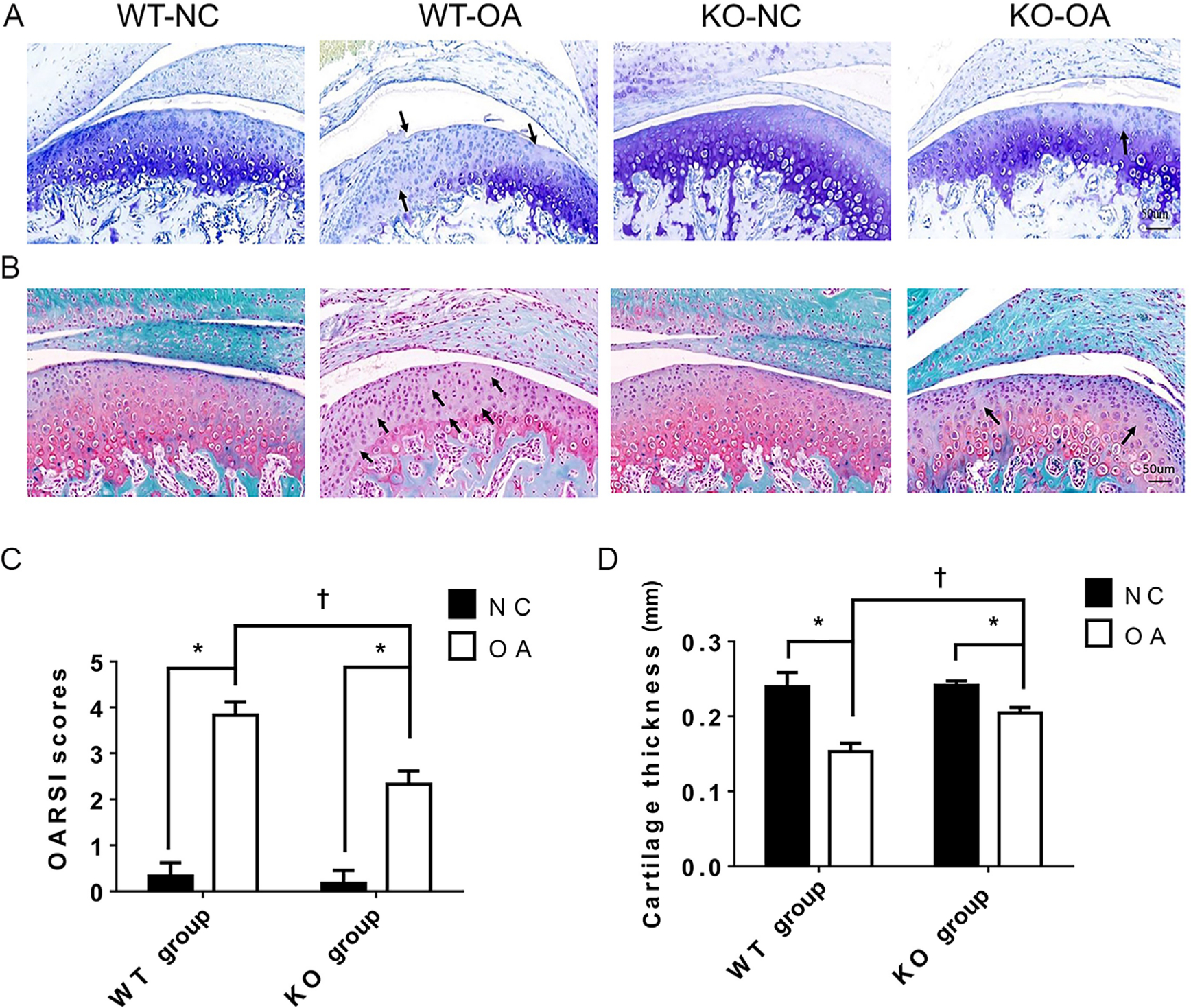 Fig. 2 
            Histological changes observed and measured after osteoarthritis (OA) treatment and the microRNA miR21-5p (MiR21) knockout. a) and b) Representative images (magnification: 30×) of toluidine blue and Safranin O staining of cartilage from knockout (KO) and wild-type (WT) mice with or without unilateral anterior crossbite (UAC)-induced OA. The arrows indicate areas of degraded cartilage, manifested by local loss of proteoglycans and cell reduction or cell loss. c) Osteoarthritis Research Society International (OARSI) scores in the KO-NC, WT-NC, WT-OA, and KO-OA groups. d) The mean of cartilage thickness in the respective groups. The data are represented as the means ± standard error of the mean (SEM) (n = 10 mice per group). Two-way analysis of variance (ANOVA) corrected with the Bonferroni correction was used to identify significant differences in multiple comparisons. The asterisk (*) and dagger (†) symbols indicate p-values of 0.05. *Comparing between NC and OA groups; †comparing between WT-OA and KO-OA groups. Scale bar: 50 μm. NC, control.
          