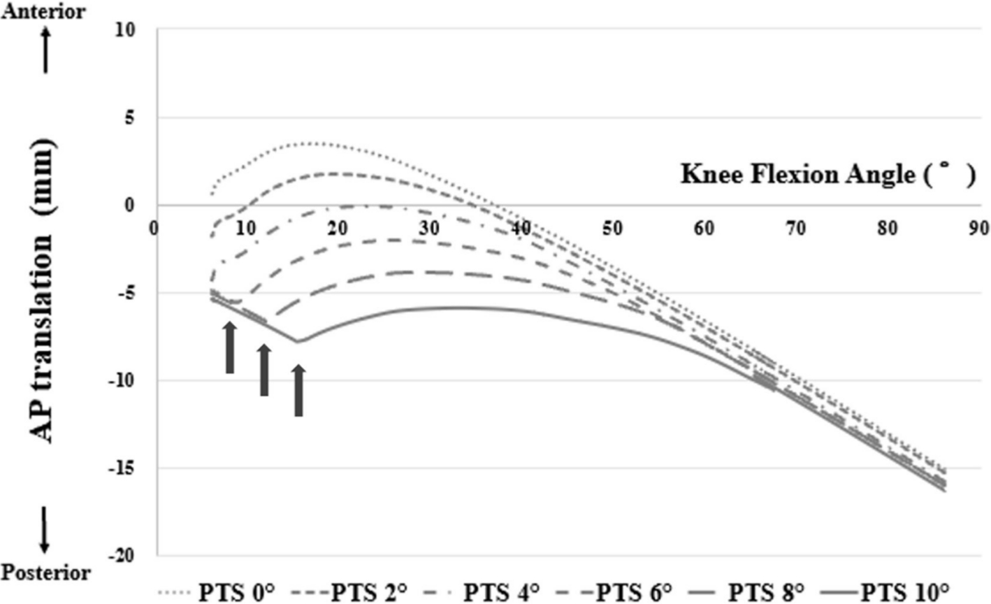 Fig. 2 
            Anteroposterior (AP) translation of the femoral component relative to the tibial insert during stair climbing using bi-cruciate stabilized (BCS) total knee arthroplasty (TKA). The arrows indicate points at which the femoral component has moved forward due to anterior post-cam contact (posterior tibial slope (PTS) of 6°, 8°, and 10°).
          