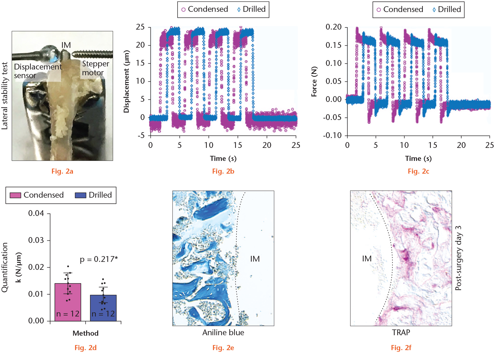 Fig. 2 
            Condensation does not improve implant (IM) primary stability. a) Experimental system used to evaluate lateral stability of implants placed in osteotomies created by drilling or condensation. A stepper motor delivered a defined displacement (Δx) at a specified height along the implant, and the resulting force was recorded. b) and c) Representative recordings of force (measured in newtons) and displacement (measured in microns) from a trial run. Initial mechanical (primary) stability was equivalent, regardless of whether the implant was placed into an osteotomy created by condensation or drilling bone. d) The slope of the F/Δx plot was calculated from the linear portion of the trace quantified. e) Aniline Blue staining and f) tartrate-resistant acid phosphatase (TRAP) activity on representative tissue sections from a case where the implant was placed into condensed group on post-surgery day three; dotted line represents bone-implant interface. *Paired t-test.
          